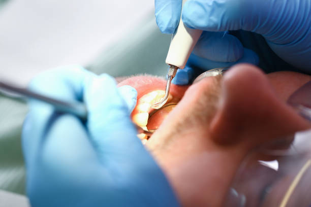 Best Emergency Tooth Extraction in Hillsville, VA