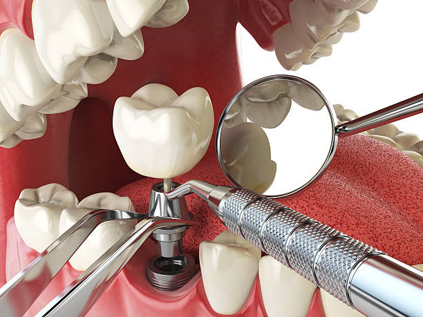 Best Emergency Dental Care for Broken or Chipped Teeth in Hillsville, VA